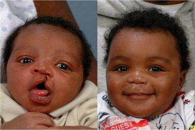 What You Need to Know About Cleft Lip and Cleft Palate – Beyond Smile 247